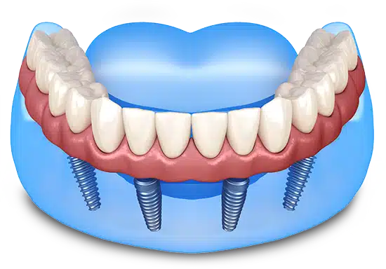 Dental implant model showing prosthetic teeth attached to four implants in jawbone.