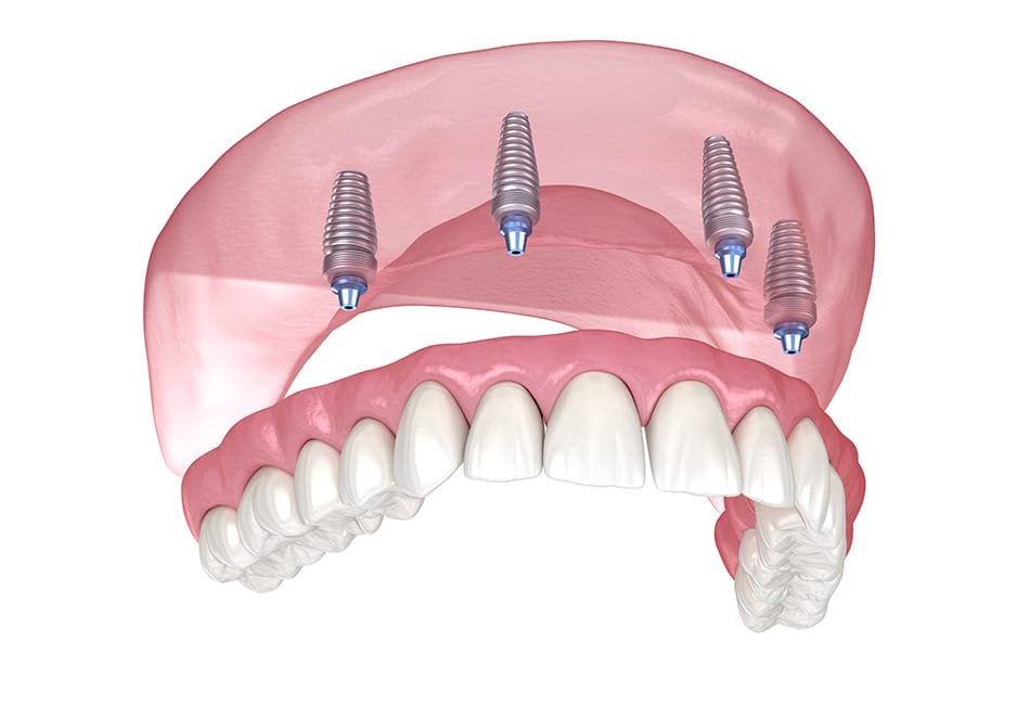 Dental implant supported bridge prosthesis with four implants on pink gum model