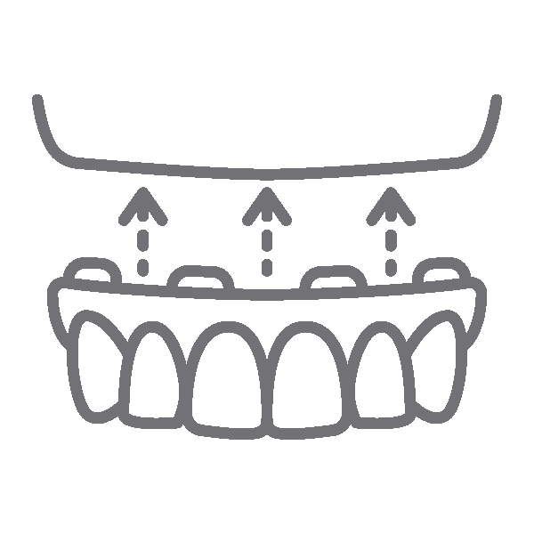 Dental implant diagram showing teeth alignment with upward arrows indicating implant placement procedure.