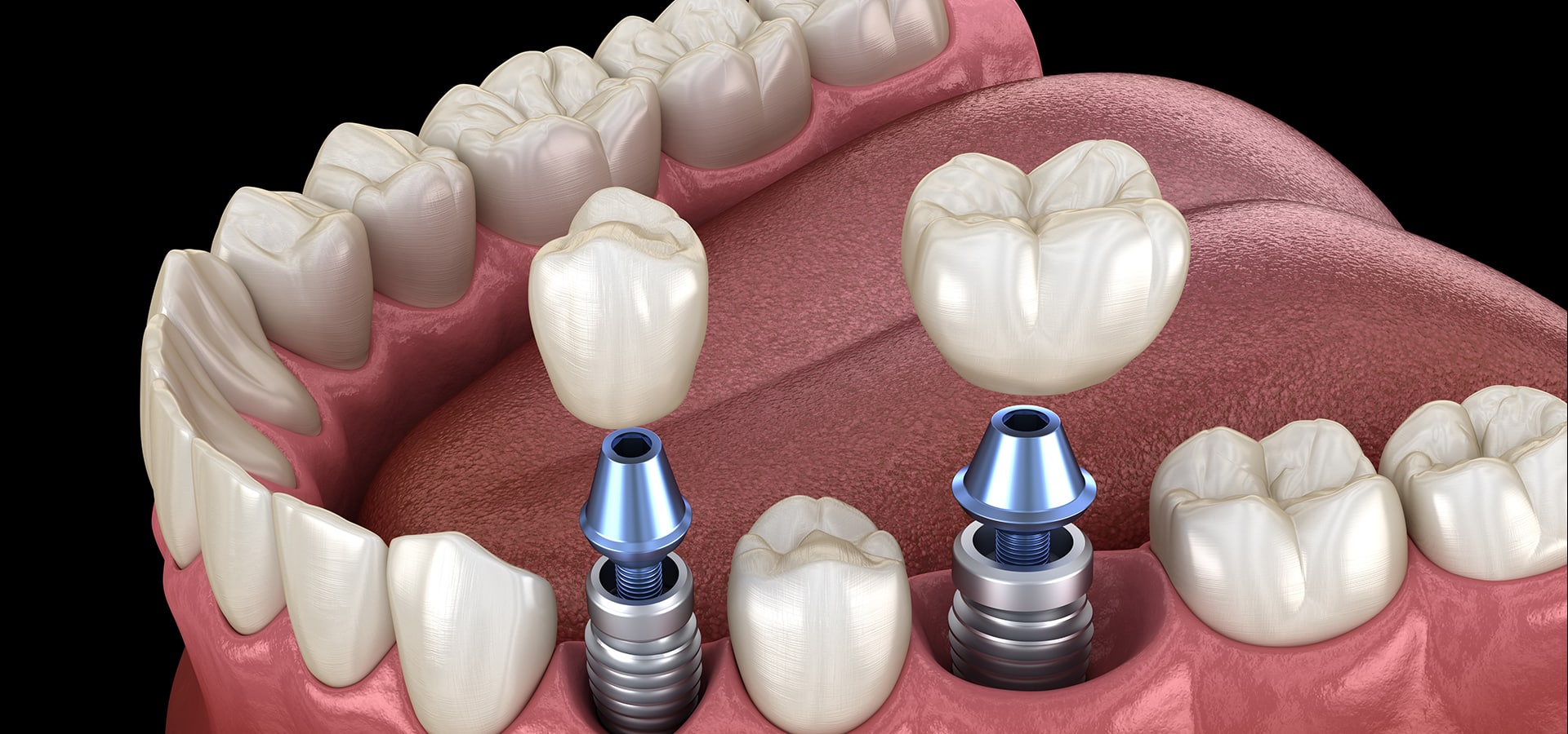 Dental implant model showing titanium posts and ceramic crowns in jawbone replica.