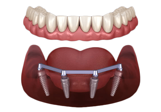 Dental implant bridge prosthesis with four titanium implants supporting artificial teeth on gum model.