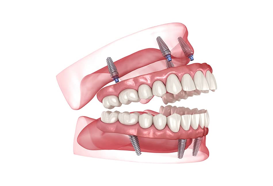 Dental implant model showing upper and lower jaw with prosthetic teeth and titanium implant posts.