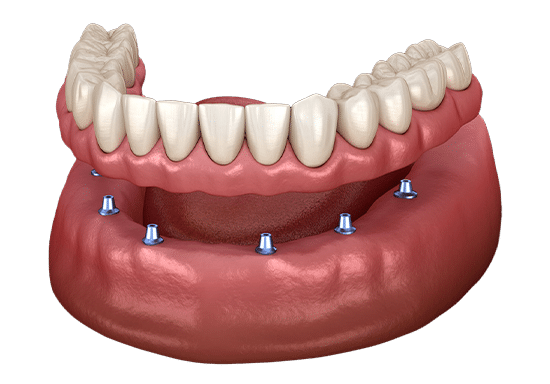 Dental implant model showing prosthetic teeth attached to jawbone with implant posts.