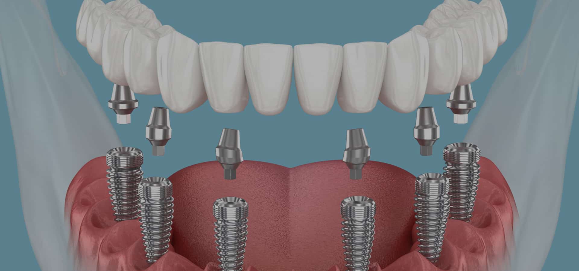 Dental implant model showing prosthetic teeth on implant posts with gum tissue representation.