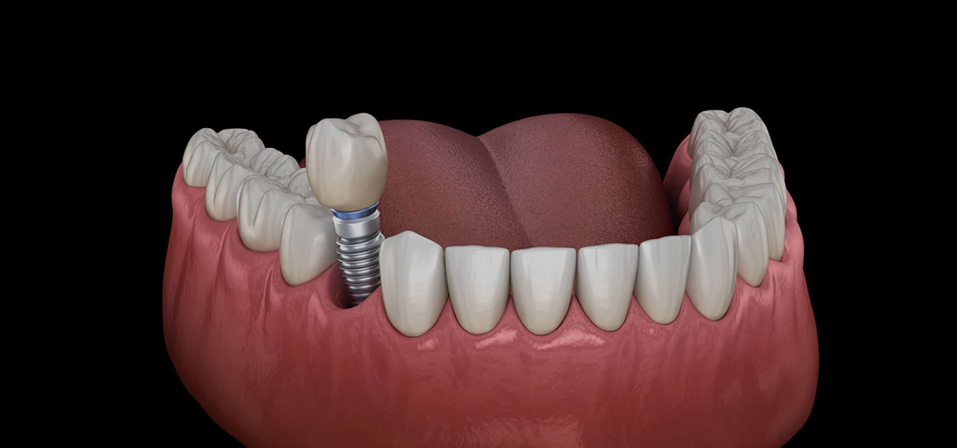 Dental implant model showing tooth replacement with crown and implant fixture in gum tissue.