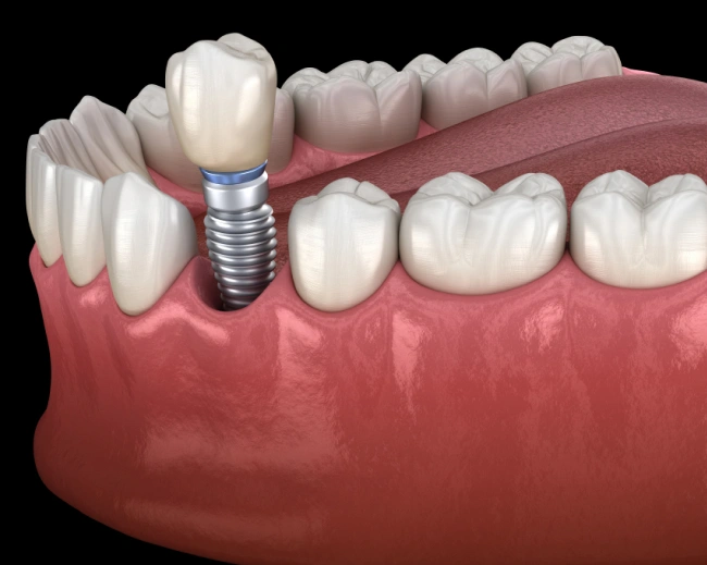 Dental implant illustration showing titanium screw fixture placed in jawbone with artificial crown tooth.