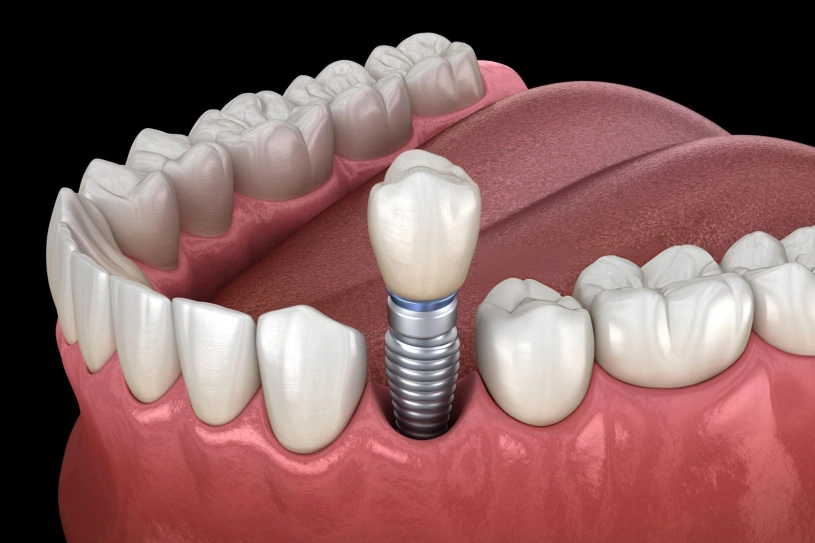 Dental implant illustration showing titanium screw placement in jawbone with artificial tooth crown.