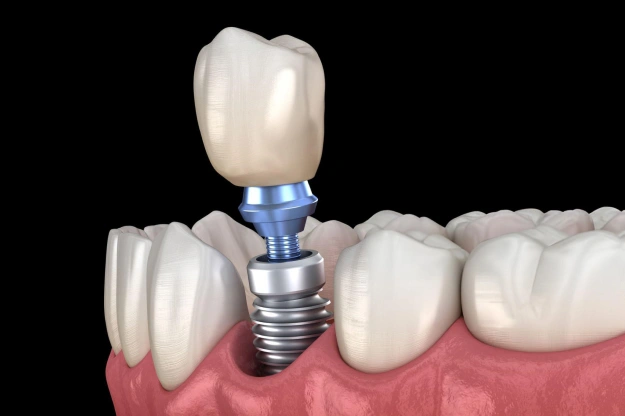 Dental implant diagram showing crown, abutment, and screw components in jawbone model.