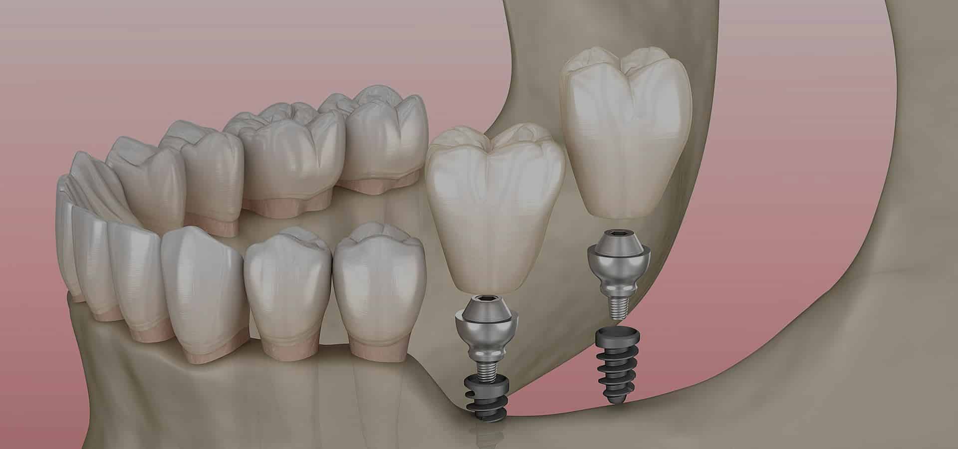 Dental implant diagram showing tooth replacement procedure with natural teeth and implant components against pink background.