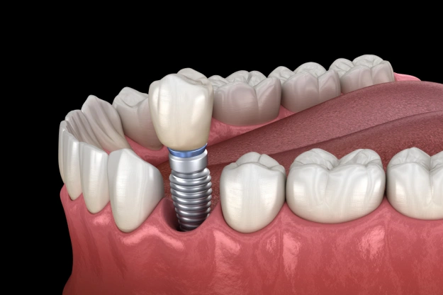 Dental implant illustration showing titanium screw placed in jawbone with crown attachment.