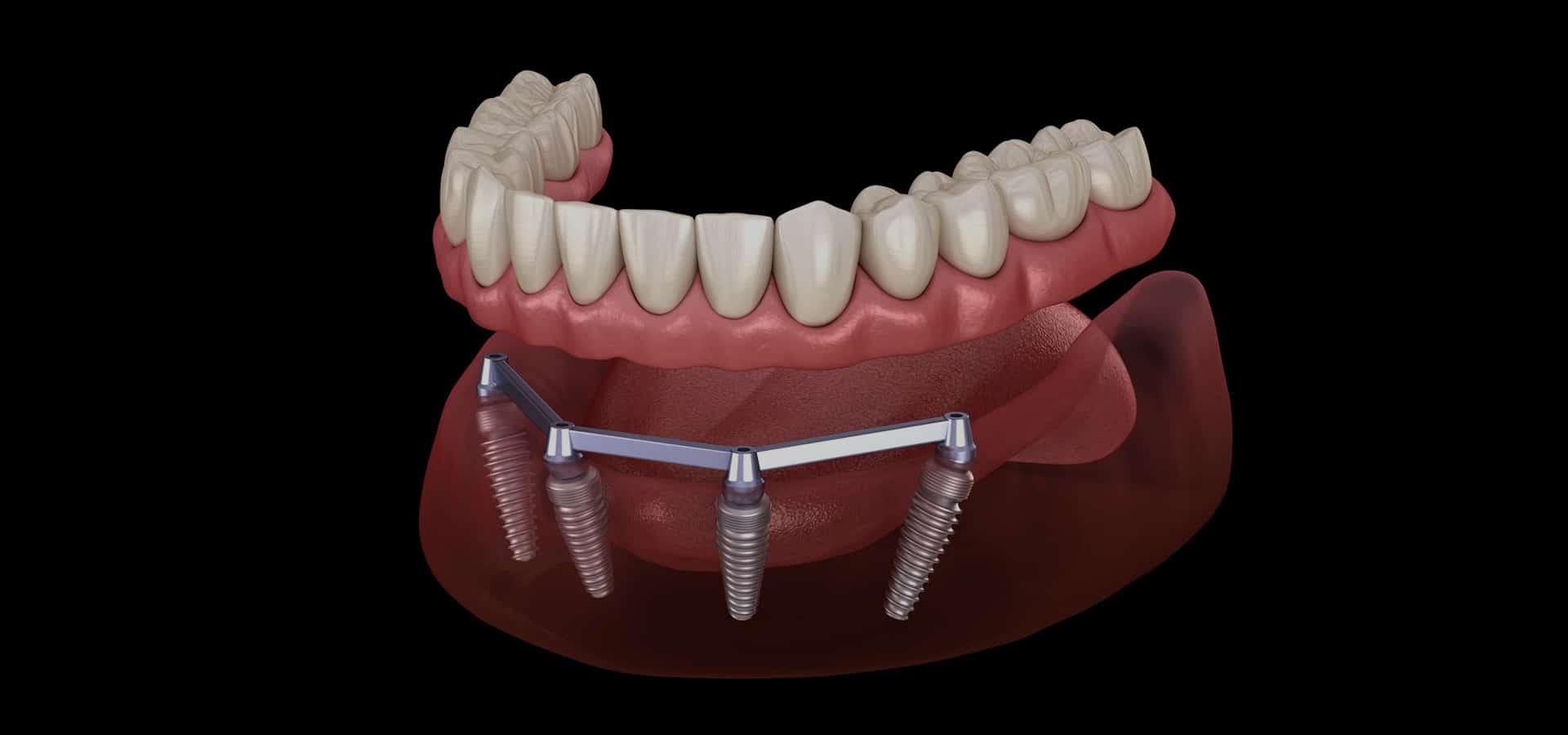 Dental implant model showing prosthetic teeth attached to implant posts in jawbone structure.