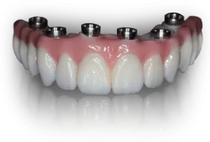 Dental implant bridge model showing prosthetic teeth with pink gum tissue and metal abutments